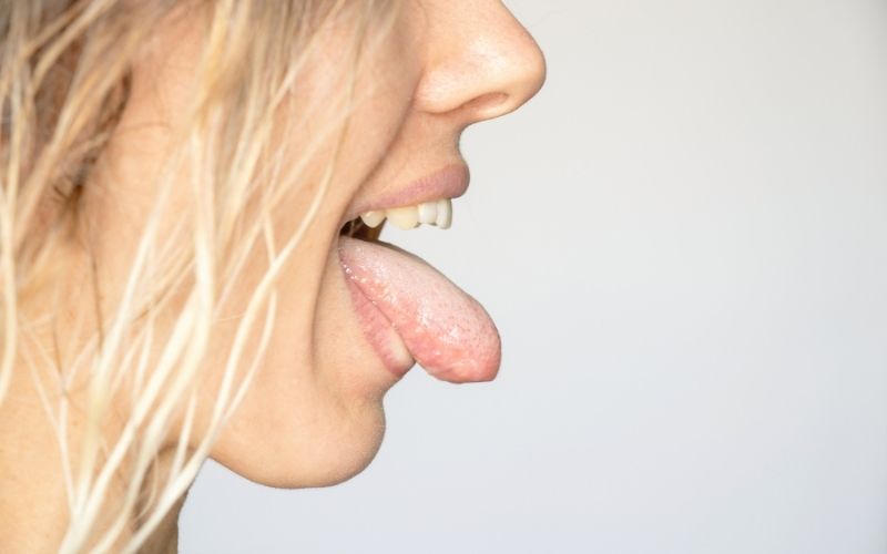 Lingua bianca cause, diagnosi e rimedi