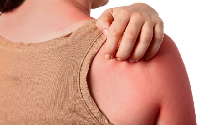 Scottature solari: cosa fare, prodotti migliori