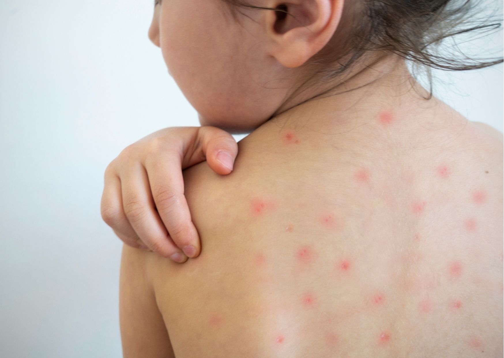 Varicella contagio, sintomi bambini e adulti e cosa fare