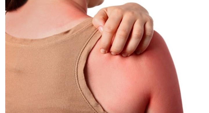 Scottature solari: cosa fare, prodotti migliori